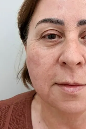 Üz konturları: Sonra
