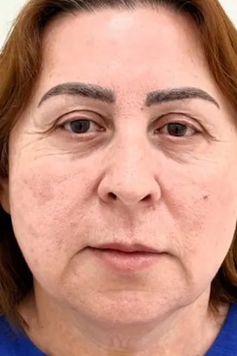 Üz konturları: Əvvəl